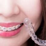 Straighten Your Smile with The Best Langley Dental Clinic